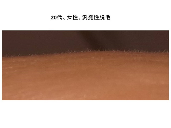 円形脱毛症　病院""